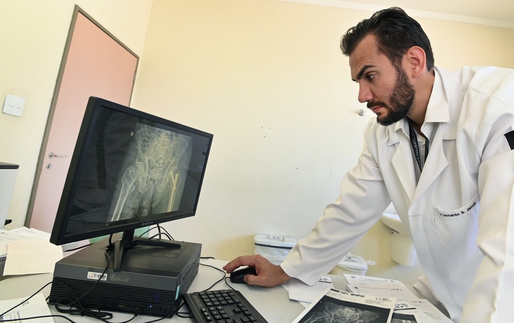 As fraturas de fêmur geralmente estão associadas a traumas envolvendo acidentes automobilísticos, quedas de altura e lesões esportivas; além de quedas em casa, principalmente em idosos